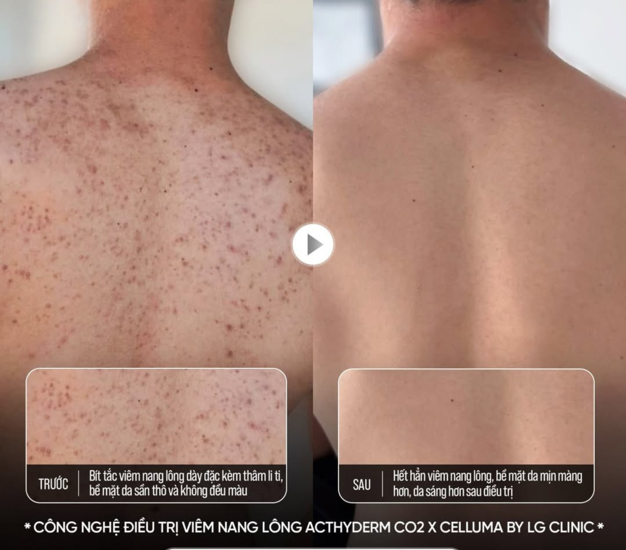 Hiệu quả thực tế sau liệu trình trị viêm nang lông và mụn lưng với công nghệ Acthyderm CO2